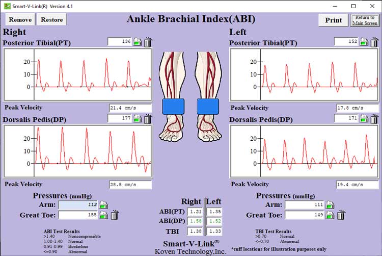 Ankle Brachial Index Screen