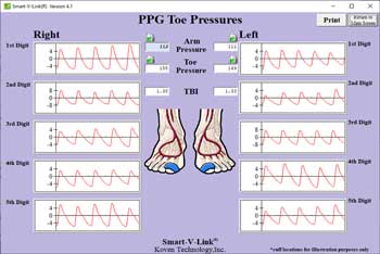 PPG Toe Pressure Screen