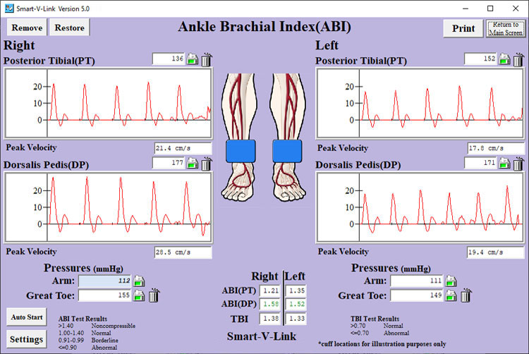 Ankle Brachial Index